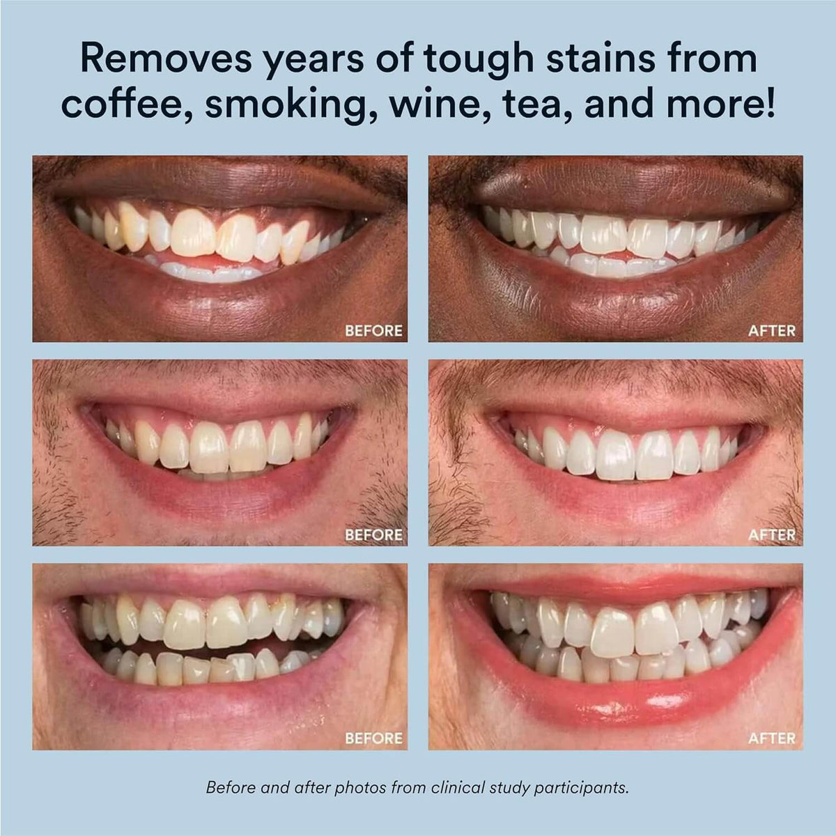 Lustrae™ - Brighter Smiles With At-Home LED Whitening