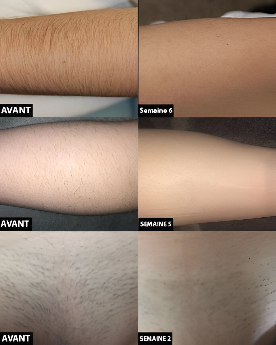 Lumelle™ - Smoother Skin Through At-Home Light Care
